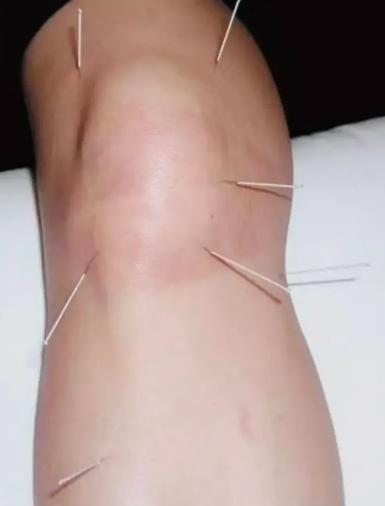 Acupuncture Therapy
